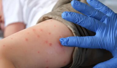 Measles patient identified at major synagogue in Bnei Brak