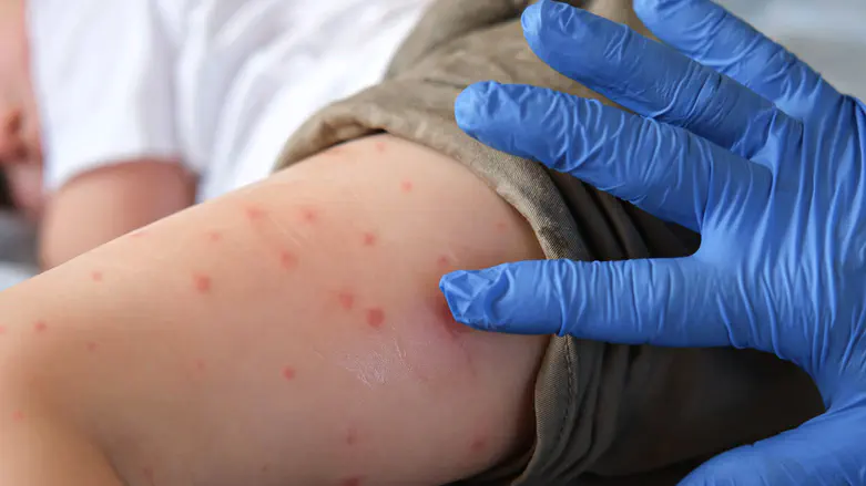 Measles patient identified at major synagogue in Bnei Brak