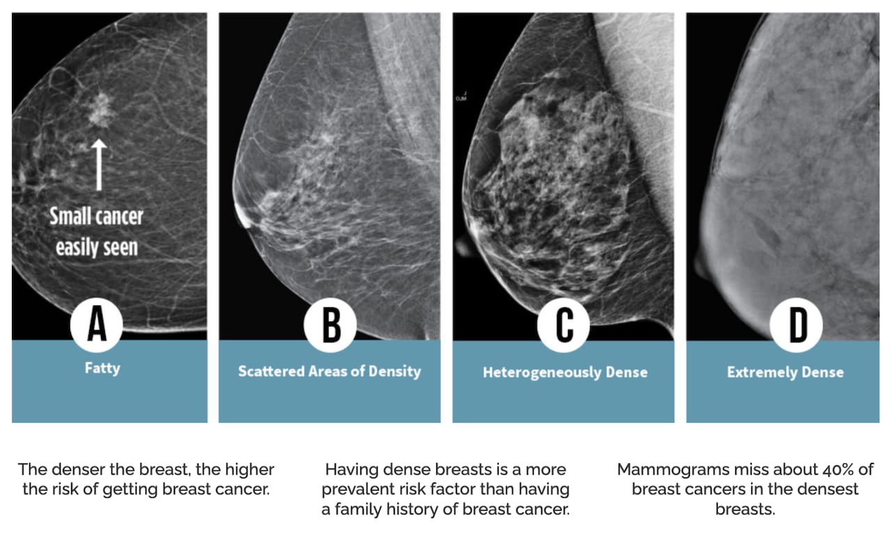 X-ray photos show differences in breast density 