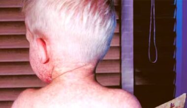 33 more confirmed measles cases in Manitoba bring total to 248 so far this year