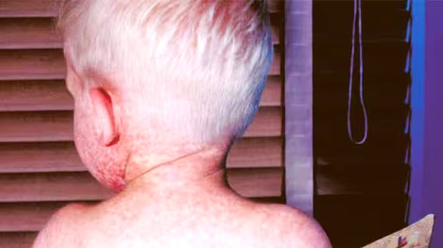 33 more confirmed measles cases in Manitoba bring total to 248 so far this year