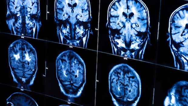 Mobile brain scans sound like science fiction. But they're now helping more Canadian patients
