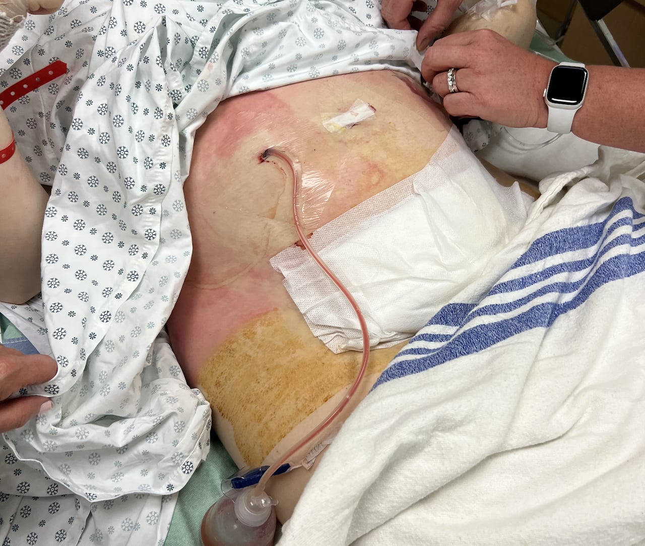 Paige Eaton's abdomen during her hospital treatment for cellulitis and sepsis, in the weeks following the C-section delivery of her son in June 2023.