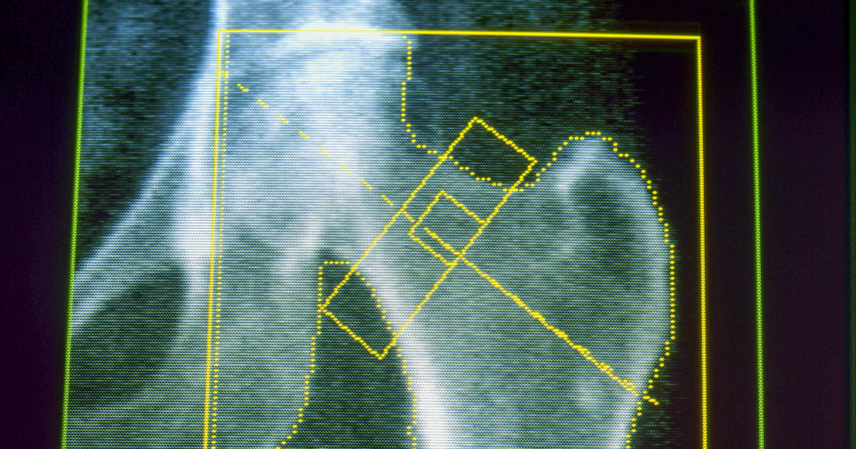 GLP-1s may increase risk of osteoporosis and gout, new research finds