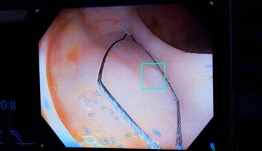 Artificial intelligence is helping 12 Fraser Health sites better assess colonoscopy findings which helps find cancers and other health problems more efficiently. (Fraser Health)