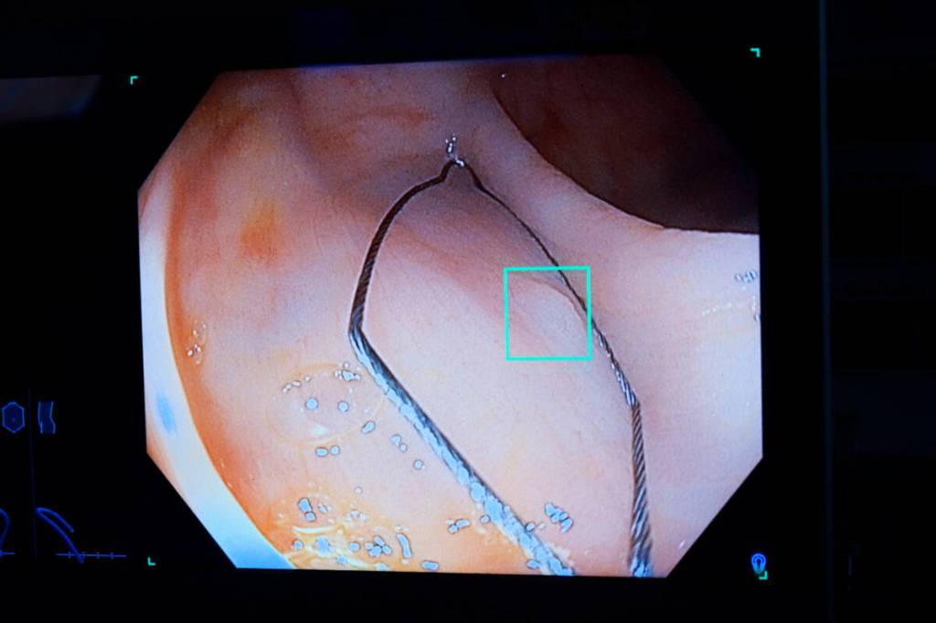 Artificial intelligence is helping 12 Fraser Health sites better assess colonoscopy findings which helps find cancers and other health problems more efficiently. (Fraser Health)