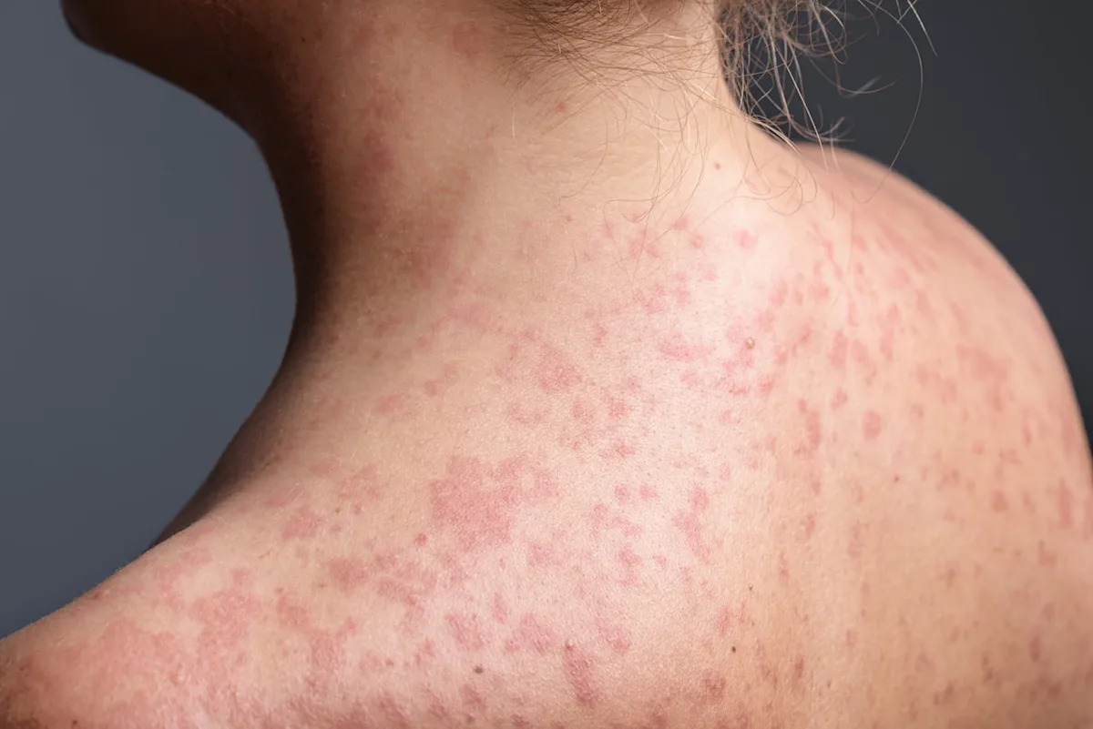 Manitoba measles cases this year increase to 291 after 43 more emerge in latest public health update