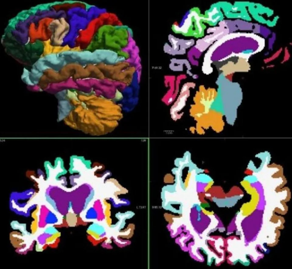 Segmented MRI images show the regions of a normal brain (Worcester Polytechnic Institute)