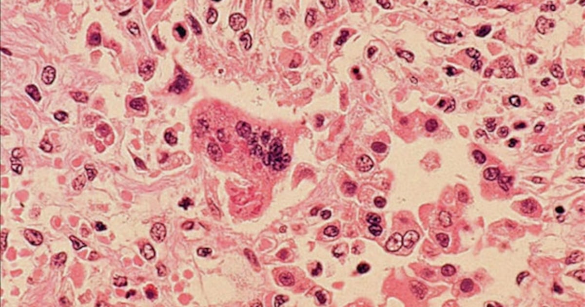 Manitoba hospital, church among new measles exposure sites - CTV News