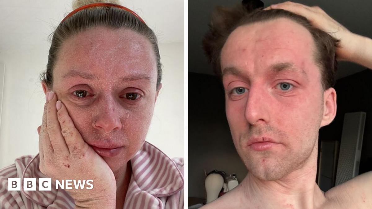 Three photos of Bethany. In the first pic she is holding her phone to take a selfie. She looks healthy and her skin is clear. In the top right pic she has shaved her hair off, in the bottom right pic her cheek skin is bright red and peeling