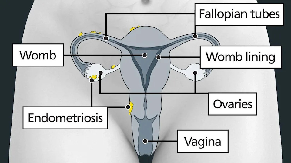 The image shows a diagram of a woman's lower abdomen, with labels identifying the female anatomy. There are yellow clumps visible on the uterus, ovaries and fallopian tubes indicating endometrioma cysts.