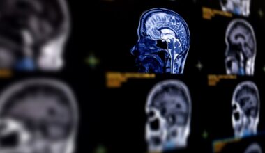 Researchers say AI can predict Alzheimer’s disease with close to 93 percent accuracy