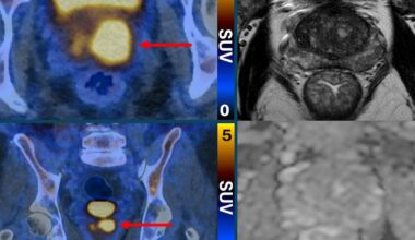 Scans That Make Prostate Cancer Cells ‘Glow’ Can Eliminate Invasive Biopsies and False Diagnoses