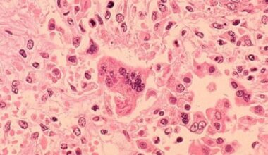 Measles case confirmed in Durham Region; public potentially exposed at Oshawa walk-in clinic and emergency department