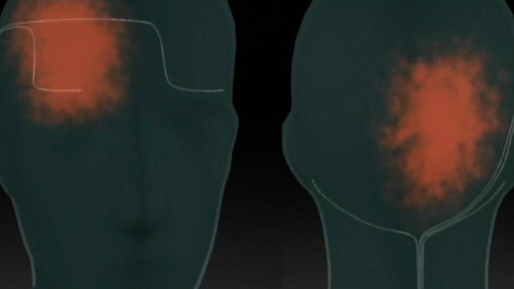 Click to play video: 'Nerve-blocking medication recommended for treating migraines in emergency departments'