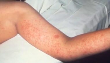 Multiple Winnipeg spots listed as potential measles locations - CTV News