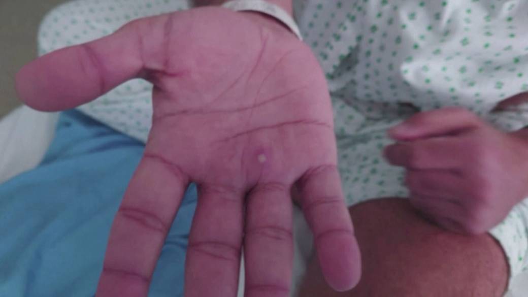 Click to play video: 'Health Matters: Mpox case with no travel history detected in England'