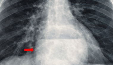 The Wandering Pancreas: A Rare Case of Complex Hiatal Hernia Presenting With Thoracic Symptoms