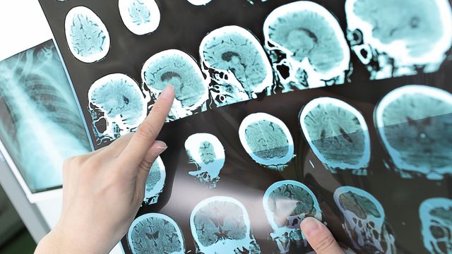 Brain Imaging Study Reveals ADHD Biotypes