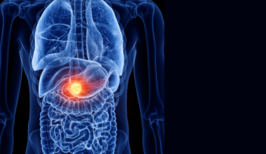 Pancreatic cancer discovery | McGill University Health Centre