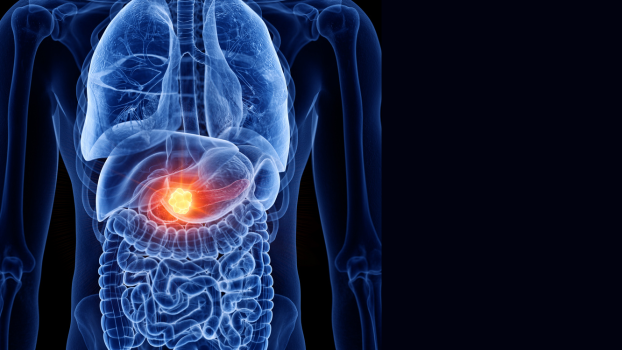 Pancreatic cancer discovery | McGill University Health Centre
