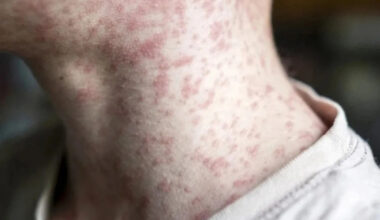 Quebec’s measles outbreak is over, but cases continue across Canada