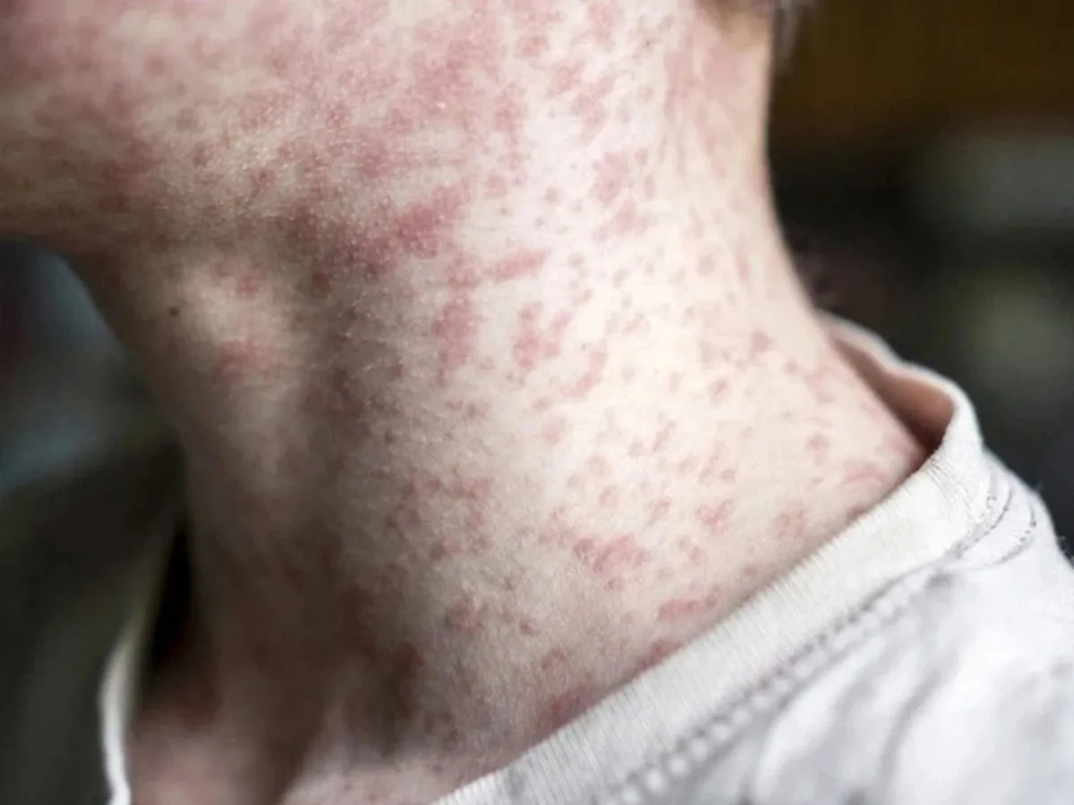 Quebec’s measles outbreak is over, but cases continue across Canada