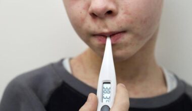 Measles cases on the rise in north London