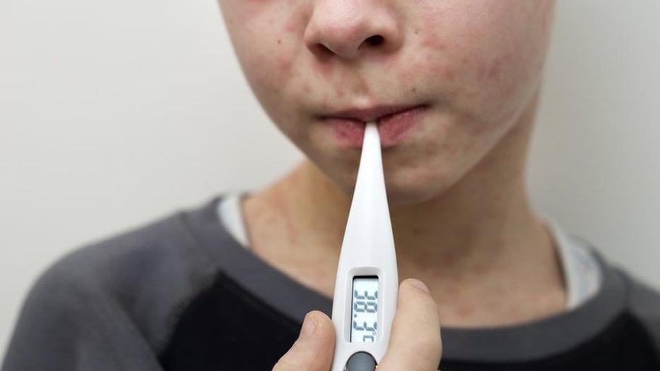 Measles cases on the rise in north London