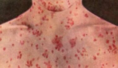 Potential measles exposures reported on 2 flights, Pearson airport: Public Health