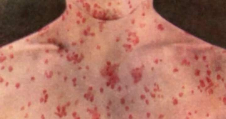 Potential measles exposures reported on 2 flights, Pearson airport: Public Health
