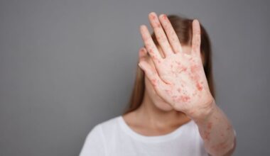 Urgent Measles Exposure Alert Issued for Brandon Clinic