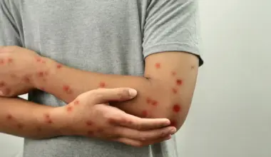 Toronto just confirmed first cases of mpox clade Ib, here’s what you need to know about the disease