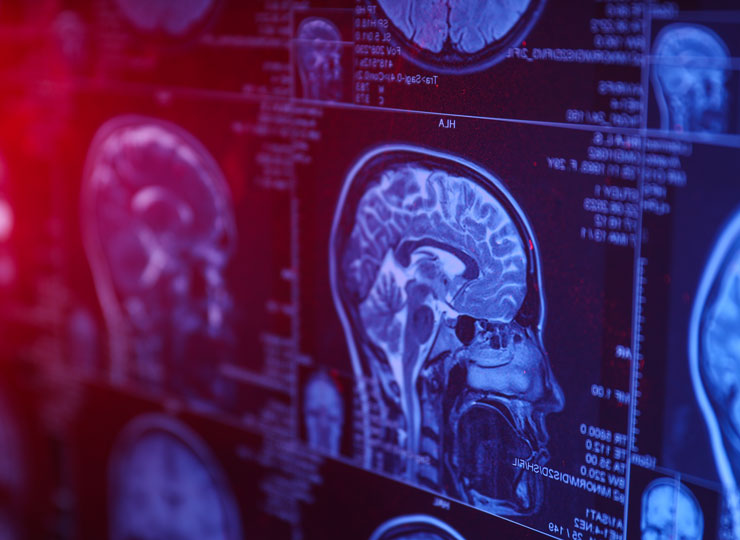 Fighting Inflammation May Help Protect Your Brain