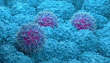 Pancreatic cancer drug daraxonrasib from Revolution Medicines succeeds in trial