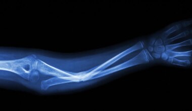 An x-ray image of an ulnar fracture.