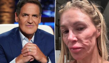 Brandi Glanville turned to Mark Cuban for help with six-figure medical bills from facial disfigurement