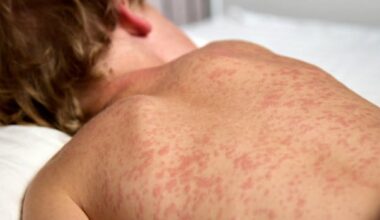 Manitoba health officials report 25 more measles cases as province remains national hotspot