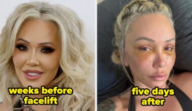 Celebrities Before And After Facelifts