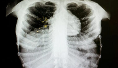 Tuberculosis found in Prince Albert homeless shelter