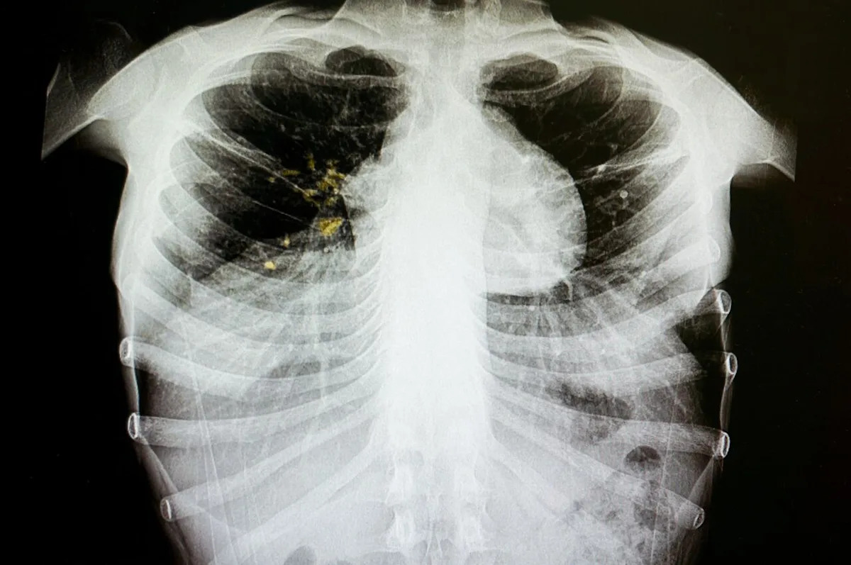 Tuberculosis found in Prince Albert homeless shelter