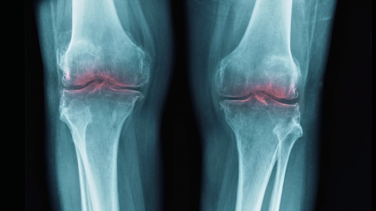 Breakthrough to Restore Aging Joints Could Help Treat Osteoarthritis : ScienceAlert