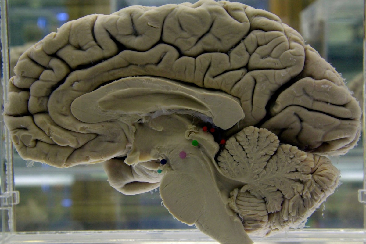 Neuropathologists urge Ottawa to bring back autopsy services for patients suspected of having fatal brain illness