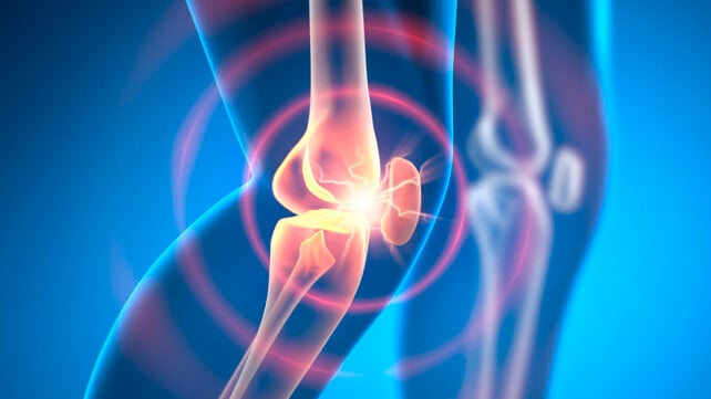 X ray illustration of a walking man with pain in knee joint