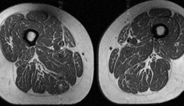 Ultraprocessed foods turning human thighs into marbled steaks