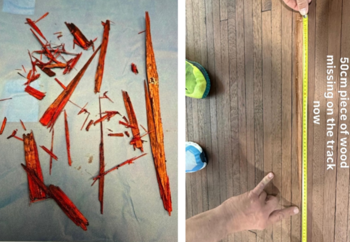 "Only a few centimetres could have meant a career-ending injury": Gruesome 50cm splinter surgically removed from track cyclist's leg after crash + more on the live blog - Cycling News | Bike Reviews