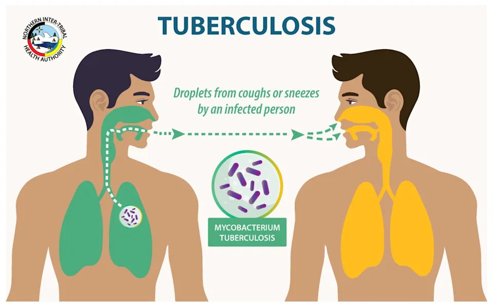NITHA provides awareness and education about Tuberculosis transmission and treatment.