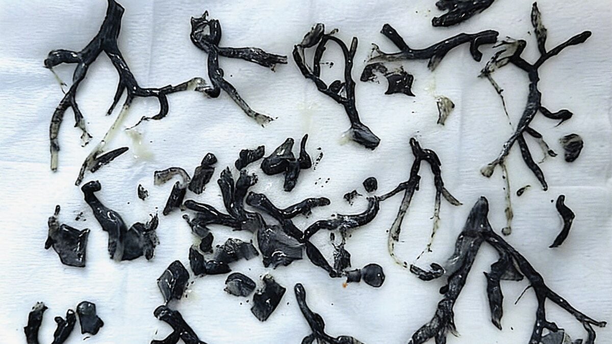 Black Gunk Found in Man's Lungs Exposes an Even Darker Side of Wildfire Smoke