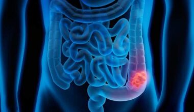 1 province is lowering colorectal cancer screening age and more could follow