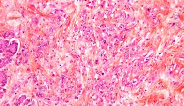 New drugs take aim at one of cancer’s deadliest mutations